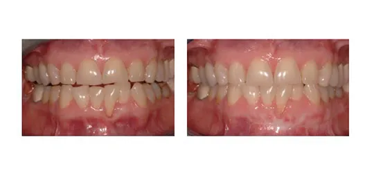 gingival graft alloderm